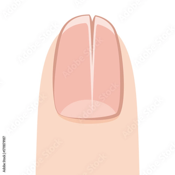 Obraz 亀裂の入った爪・爪甲縦裂症