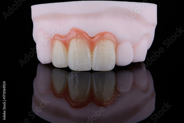 Fototapeta High-quality three dental crowns made of zirconium for fixation to the frontal teeth of upper jaw.