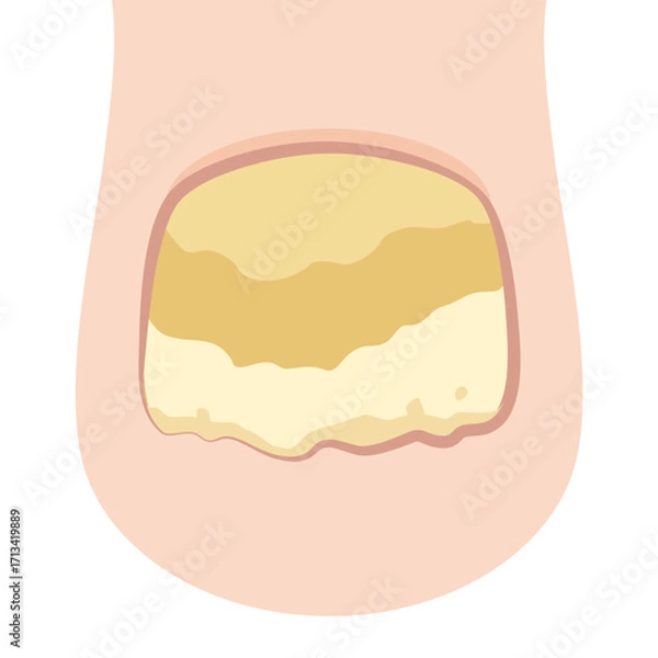 Obraz 爪白癬・爪水虫