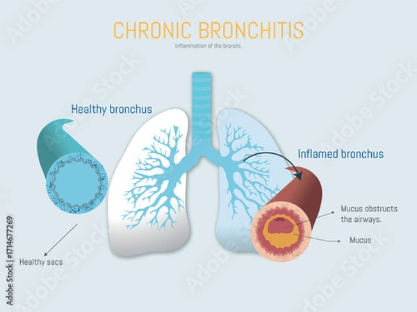 Fototapeta Chronic bronchitis showing inflamed and healthy bronchus comparison