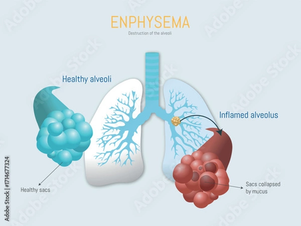 Fototapeta Emphysema destroying alveoli, showing healthy and inflamed lung sacs