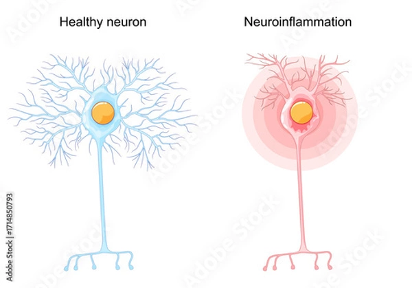 Fototapeta Neuroinflammation. Healthy neuron and unhealthy nerve cell
