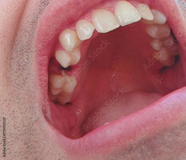 Fototapeta open mouth of a man with the place of pulled out small molar tooth, healing of a wound in the place of the tooth.