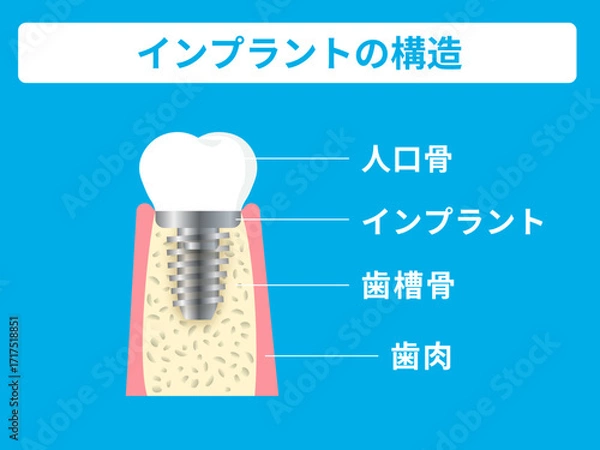 Fototapeta インプラント,歯科,人工歯根,チタン,歯槽骨,オッセオインテグレーション,顎骨,インプラント治療,歯科手術,インプラント体,アバットメント,上部構造,クラウン,歯の欠損,義歯,部分入れ歯,ブリッジ代替,歯科医師,歯科衛生士,歯科医院,デンタルケア,歯科器具,ドリル,口腔外科,CT撮影,骨造成,抜歯後治療,歯肉切開,縫合,骨結合,口腔模型,レントゲン,3Dイメージ,歯科解剖,歯列修復,補綴,噛み合わ