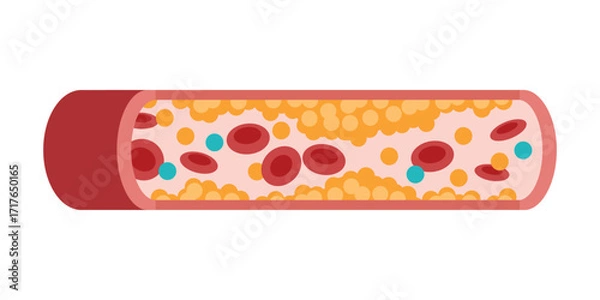 Fototapeta Type of cholesterol in human blood vessels. Low-Density Lipoprotein LDL. High-Density Lipoprotein HDL. Normal artery, blocked vascular, fatty streak, plaque, Moderate. Medical Vector illustration.