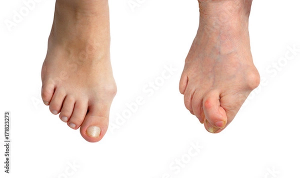 Obraz Medetcin, valgus bunion, Initial stage and advanced stage of the disease , leg with deformity valgus hallux (Bunion), the consequence of refusal of treatment, space for text