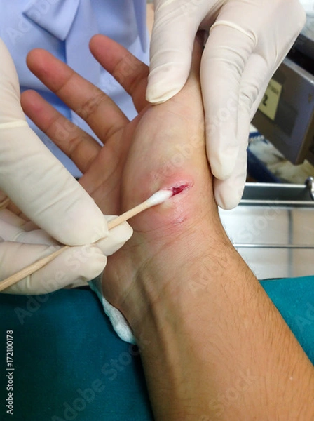 Fototapeta Puncture wound on hand skin from dog bite. Crazy dog bite on injured skin surgery to prevention inflame in hospital. Injury fresh inflame puncture wound from dog bite on hand skin concept. 