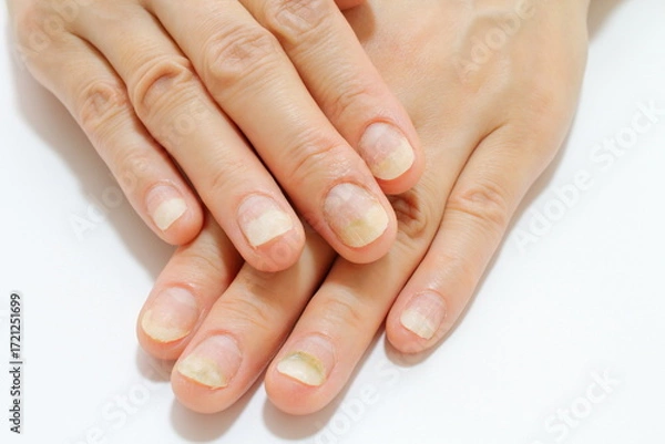 Obraz 爪トラブル（爪甲剥離症と緑色爪症）