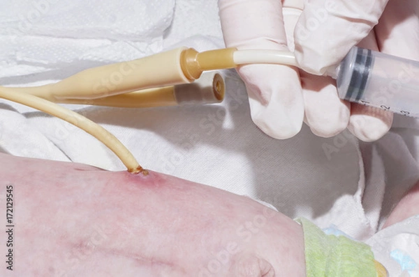 Obraz Pielęgniarka karmi przez zgłębnik po gastrostomii noworodka na oddziale intensywnej terapii noworodka w szpitalu dziecięcym
