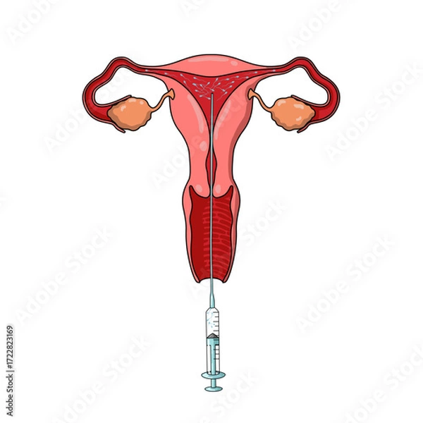 Fototapeta Illustration of Intrauterine Insemination, IUI treatment, Sperm Donor, pregnancy planning, egg and sperm cells, vector illustration for medical posters, clinics, and education