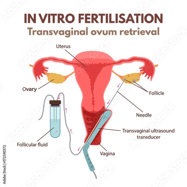 Obraz In vitro fertilisation