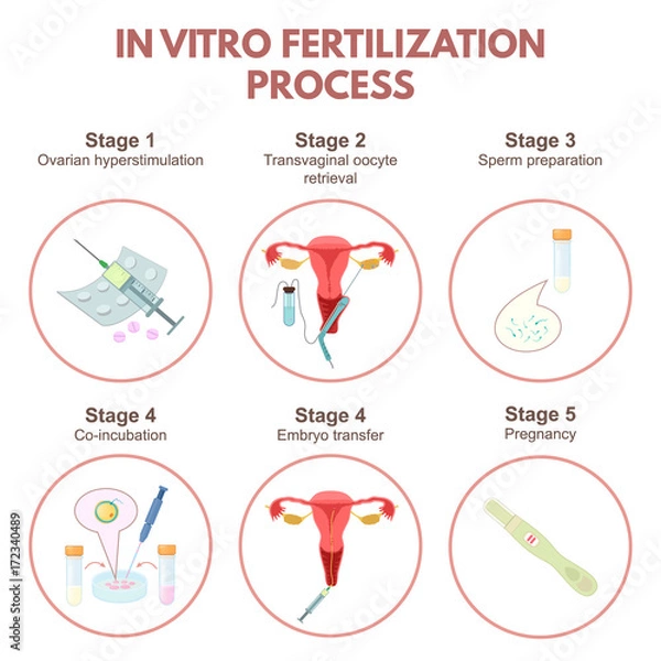 Obraz In vitro fertilization
