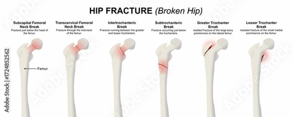 Fototapeta Hip Fracture (Broken Hip) Bone Flashcard Illustration