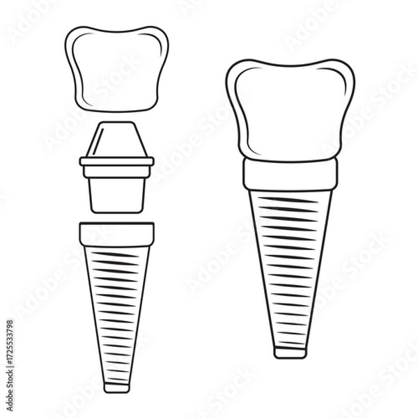 Fototapeta Dental implant, contour. Screw prosthesis, Illustration of dental implantation,orthodontic dental implantation