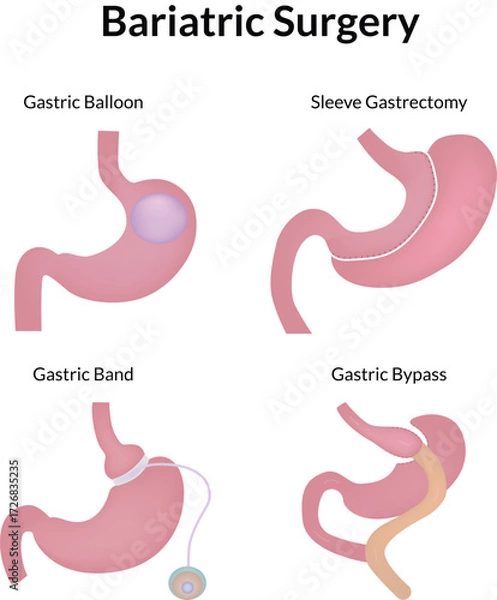 Fototapeta Bariatric Surgery Procedures Gastric Balloon Sleeve Band and Bypass Vector Illustration