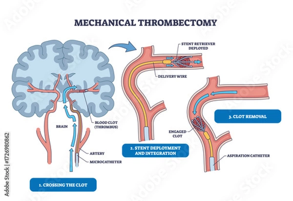 Fototapeta Mechanical thrombectomy diagram shows brain, artery, and stent illustrating clot crossing, stent deployment, and clot removal steps. Outline diagram