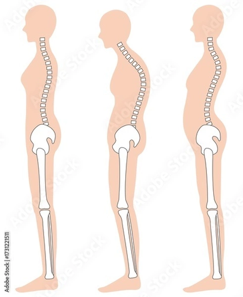 Obraz 正しい姿勢と猫背と反り腰の女性　背骨と骨盤