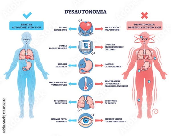Fototapeta Dysautonomia overview showing differences in autonomic function with human figures, organs, and symptom icons. Outline diagram