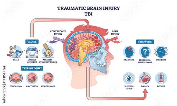 Fototapeta Traumatic brain injury is shown with a side-view head, brain impact zones, and labeled symptoms and causes. Outline diagram