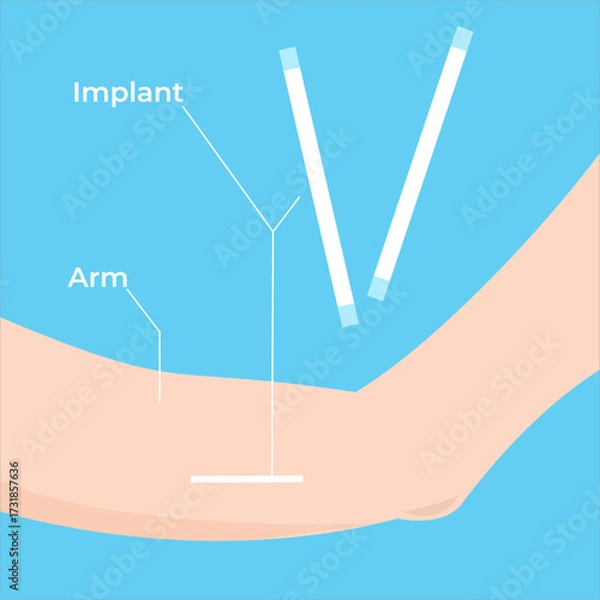 Fototapeta Illustration of contraceptive method using under-skin implant, great for reproductive health or medical education, flat art design style.
