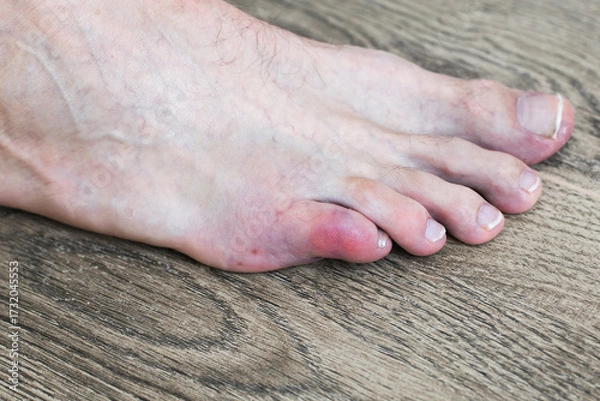 Fototapeta Injured little toe with visible swelling and bruising indicating a possible fracture on a wooden floor background, concept of home accident and foot injury