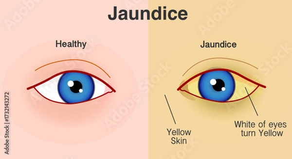 Fototapeta Jaundice. Yellowing of the skin and whites of the eyes. Increased bilirubin levels in the blood. mucous membranes. Vector illustration