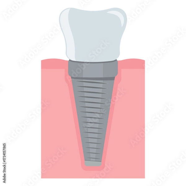 Fototapeta Dental implant. Screw prosthesis, Illustration of dental implantation,orthodontic dental implantation