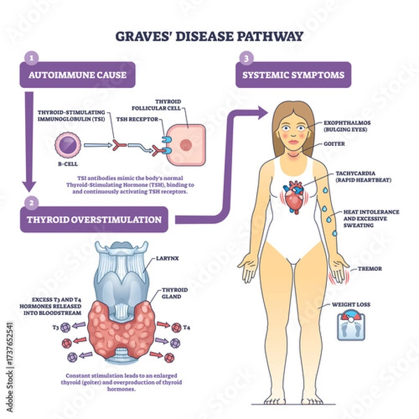 Fototapeta Graves disease pathway brief diagram explains autoimmune antibodies overstimulating the thyroid with a patient figure showing symptoms, thyroid, antibodies, woman. Outline diagram