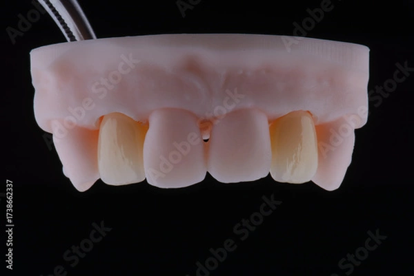 Fototapeta High-quality dental single crowns made of zirconium for fixation to the frontal teeth of upper jaw.