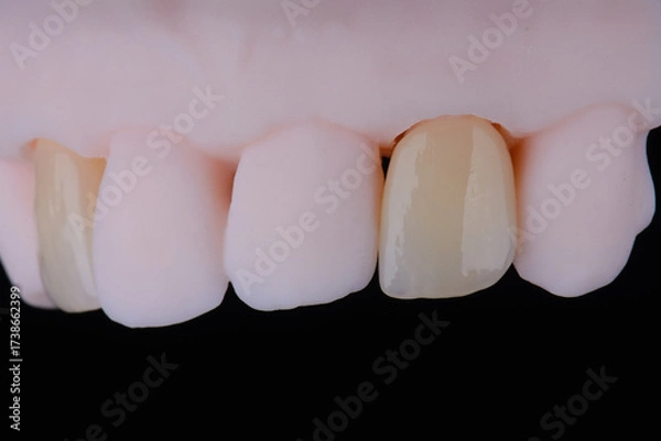 Fototapeta High-quality dental single crowns made of zirconium for fixation to the frontal teeth of upper jaw.