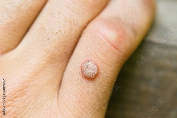 Obraz Wart on the hand finger. 