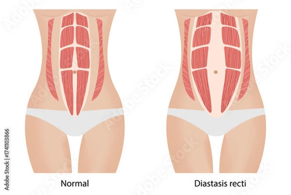 Fototapeta Diastasis recti. Separation of the muscles