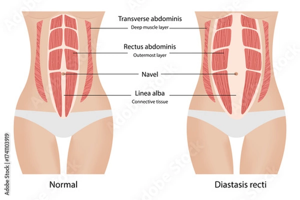 Fototapeta Diastasis recti. Separation of the muscles