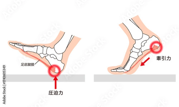 Obraz 足底筋膜炎　足底筋膜　足底腱膜　足の筋肉