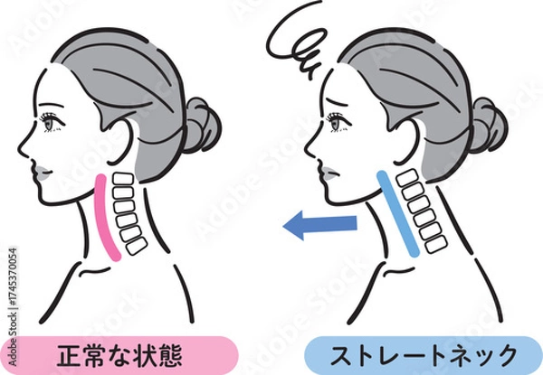 Fototapeta 正常な状態とストレートネックの比較イラスト（女性横顔）