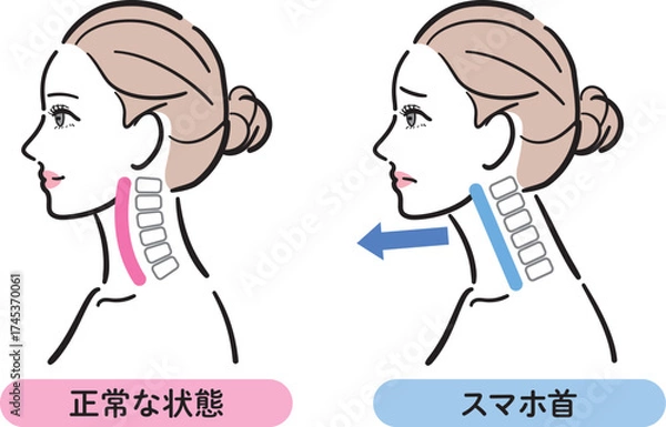 Fototapeta 正常な状態とスマホ首の比較イラスト（女性横顔）