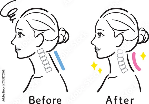Fototapeta ストレートネックから正常な状態への変化イラスト（女性横顔・ビフォーアフター）