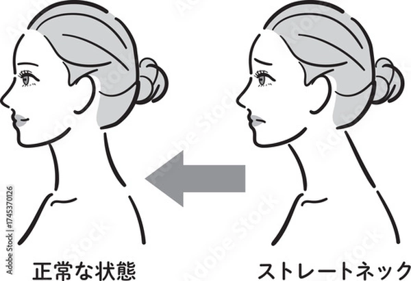 Fototapeta 正常な状態とストレートネックの比較イラスト（女性横顔・白黒タイプ）
