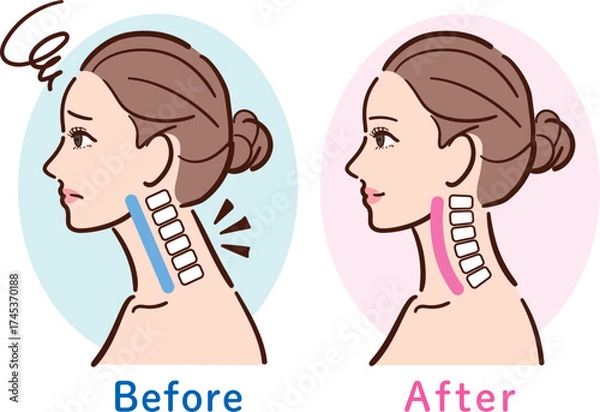 Fototapeta ストレートネックから正常な状態への変化イラスト（女性横顔・ビフォーアフター）