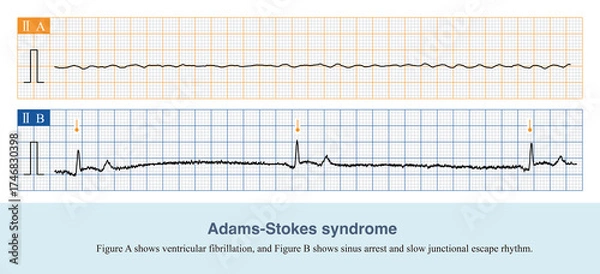 Obraz When malignant arrhythmias cause a sudden decrease in cardiac output, the patient will experience symptoms such as amaurosis, syncope, and convulsions, which is called Adams-Stokes syndrome.
