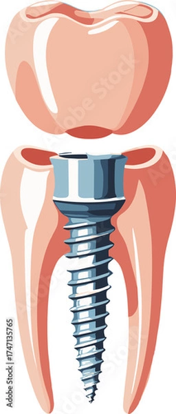 Fototapeta Realistic medical illustration of a dental implant showing a titanium screw integrated into the tooth root structure, used for educational and dental care materials.