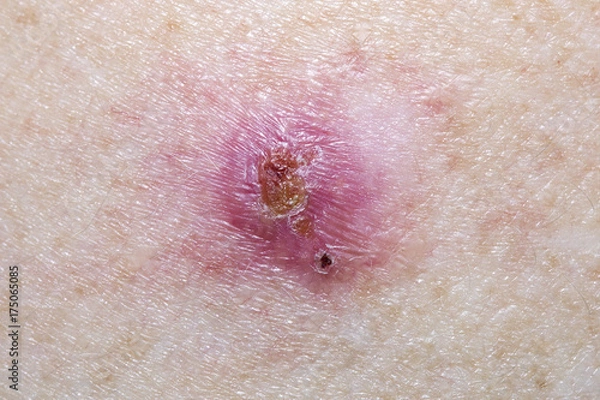 Fototapeta Basal Cell Carcinoma on a mature female 