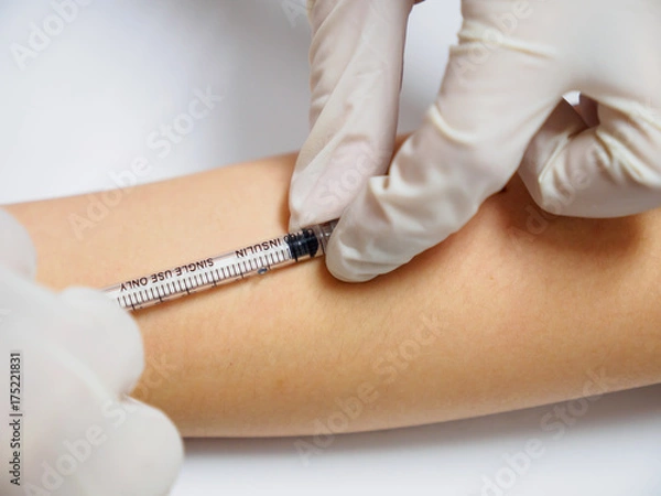Fototapeta Close-up macro detail of a physician performing a BCG vaccination using an insulin syringe on the forearm of a child. Healthcare and medicine concept.