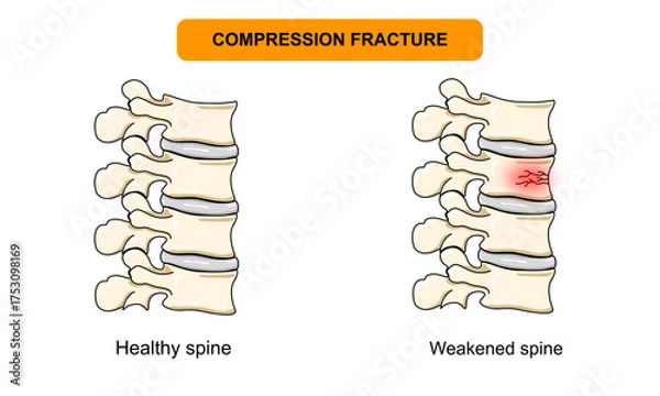Fototapeta spinal compression fracture. Vertebral compression fracture, back pain, osteoporosis. Vector illustration for medical, clinical, or educational posters.