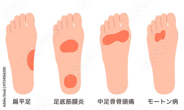 Obraz 足裏の痛み　炎症が起きる箇所