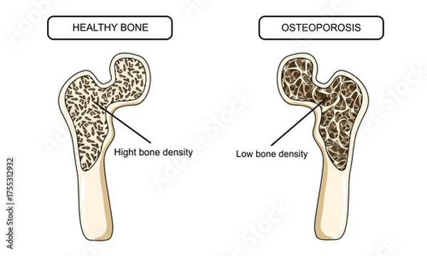 Fototapeta Illustration of osteoporosis and healthy bones. Systemic skeletal disorders, human hip bone, loss of bone mineral density. Risk of fracture. Vector illustration for medical, clinic, and education