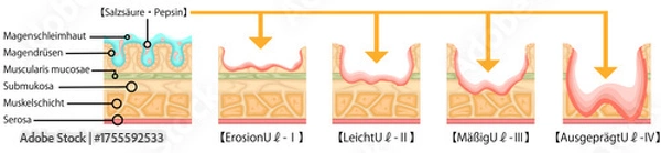 Obraz 胃潰瘍　重症度　イラスト　ドイツ語