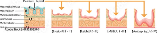 Obraz 胃潰瘍　重症度　イラスト　ドイツ語