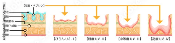 Obraz 胃潰瘍　重症度　イラスト　日本語