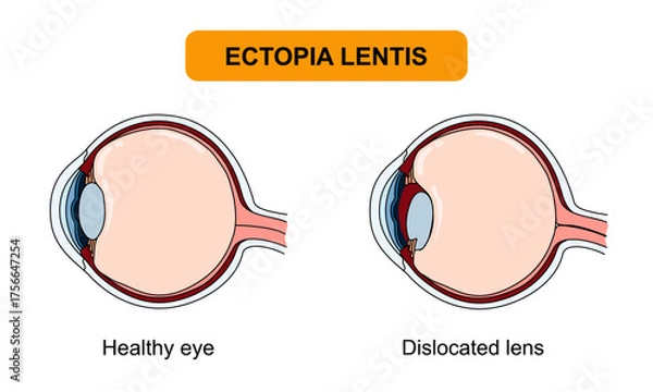 Fototapeta Ectopia lentis illustration, torn zonular fibers. Healthy eyes and vision disorders, genetic diseases. Ophthalmology appointment. Vector illustration of eye health, poster for medical and education
